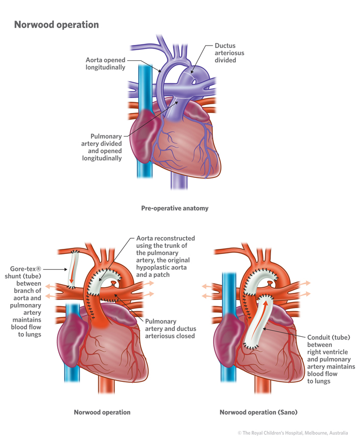 10b_Hypoplastic_left_heart_syndrome 10b_Hypoplastic_left_heart_syndrome