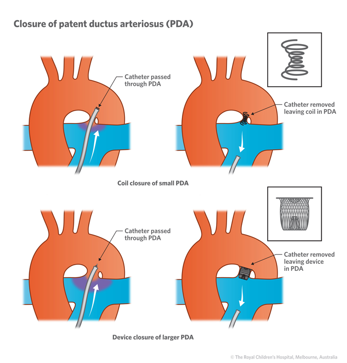 13b_Patent_ductus_arteriosus_PDA