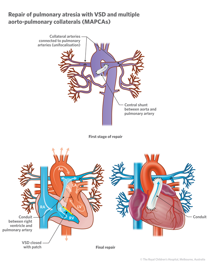 15d_Pulmonary_atresia_with_VSD 15d_Pulmonary_atresia_with_VSD