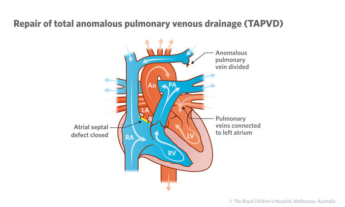 17b_Total_anomalous_pulmonary_venous_drainage