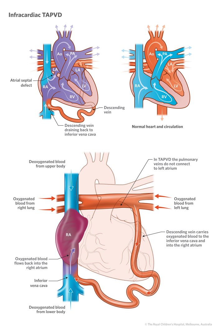 17c_Total_anomalous_pulmonary_venous_drainage