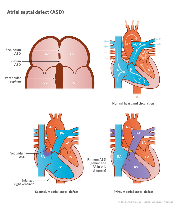 3a_Atrial_septal_defect_ASD