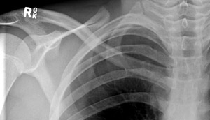 Fracture Clavicle