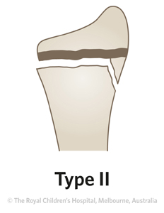Fracture-Distal-radial-physeal-ED_Section-1-and-2_SALTER-HARRIS-RADIUS-2.jpg