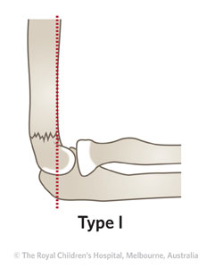 /uploadedImages/Main/Content/clinicalguide/Fracture-Supracondylar-ED_Section1_GARTLAND-FRACTURE-T1-with-line.jpg