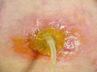 Gastrostomy cellulitis.jpg