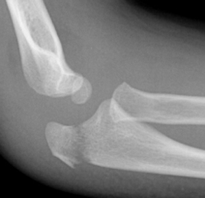 Clinical Practice Guidelines : Olecranon fracture - Emergency Department