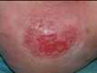 Wound-assessment-and-dressing-Picture2