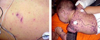purpura on the torso and back/face of a child