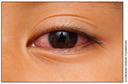 Conjunctivitis 1 Conjunctivitis 1