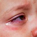 Conjunctivitis 2 Conjunctivitis 2