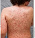 Rash 1 Rash 1