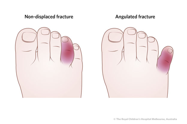 Fractured toes usually 