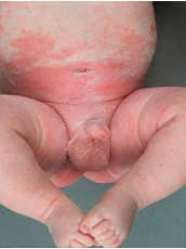 Buttock rash in children - RightDiagnosis.com