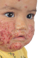 InfectedBoy.jpg