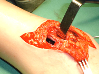 Figure-22-B-Skin-breach_Artery-and-nerve