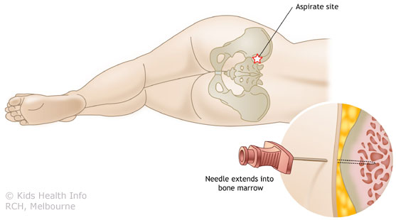 Bone Marrow Test