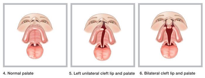 cleft palate health info cleft lip and palate an overview cleft palate health info cleft lip and palate an overview