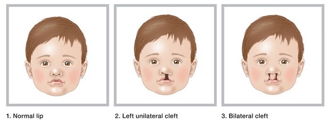 Cleft_lip_cleft_palate