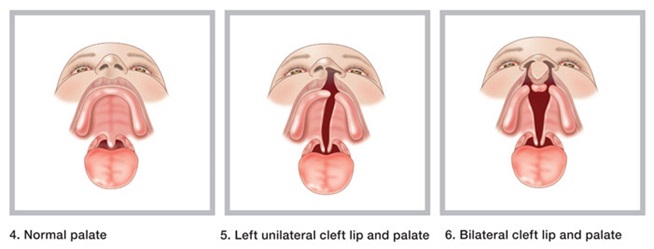 Cleft_lip_cleft_palate_1