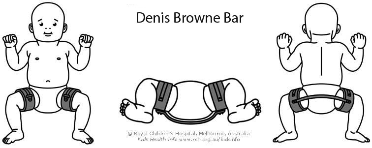 Denis Browne Splint