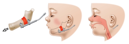 Jaw distractor post expansion