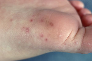 Herpes on Hands - whatisherpes.net