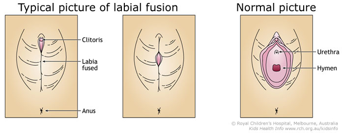 LABIAL AGGLUTINATION | Labia | Vagina