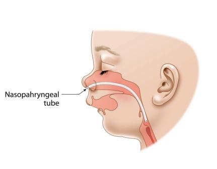 Nasopharyngeal tube