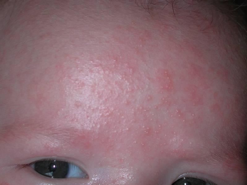 Rashes in babies and children - NHS.UK