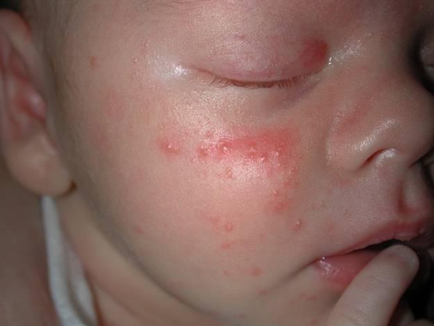 Erythema toxicum (newborn rash) | BabyCenter