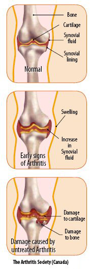 Damaged Arthritis