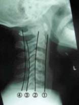 Normal lateral c-spine film