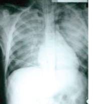 Pulmonary contusions