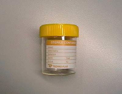 Amino Levulinic Acid, Urine