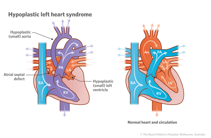 10a_Hypoplastic_left_heart_syndrome 10a_Hypoplastic_left_heart_syndrome