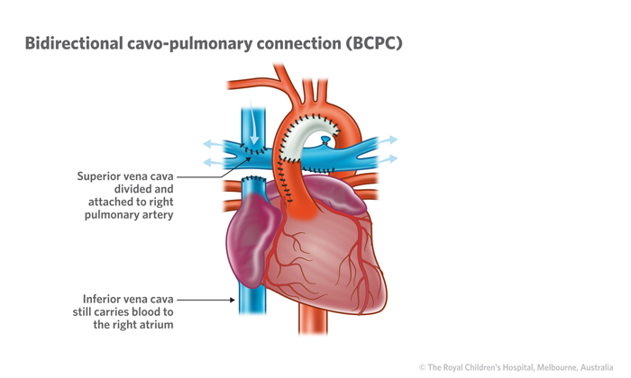 10c_Hypoplastic_left_heart_syndrome 10c_Hypoplastic_left_heart_syndrome