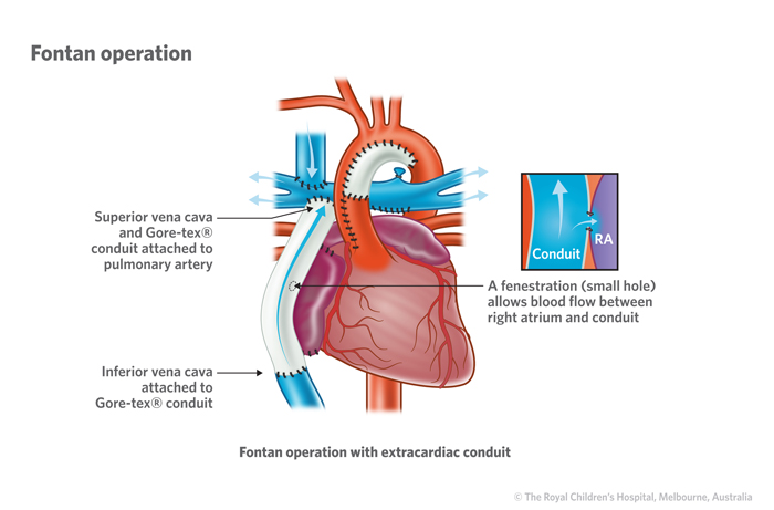 Cardiology Hypoplastic Left Heart Syndrome
