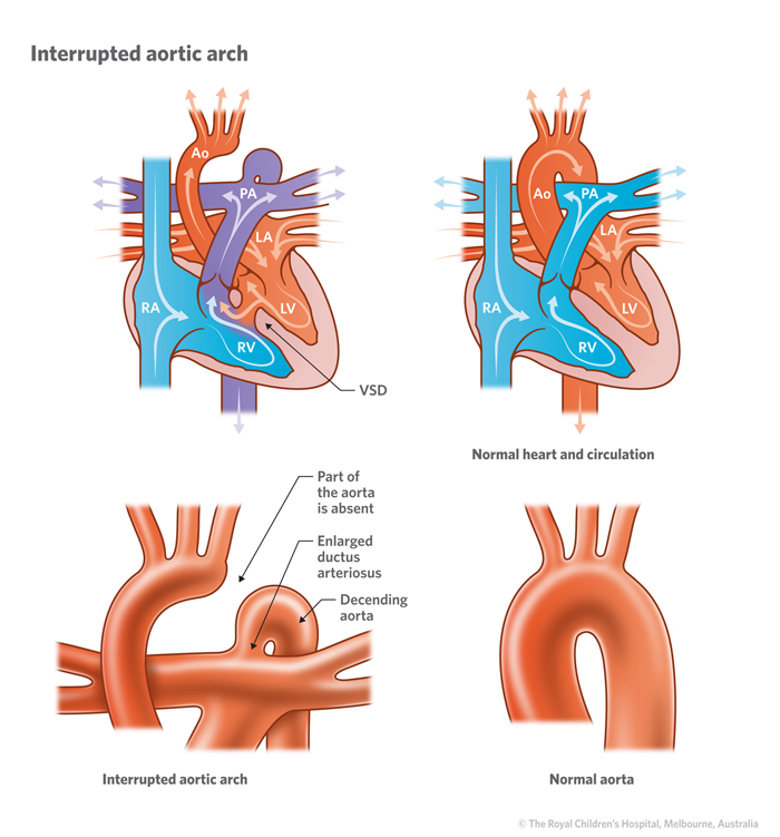 11a_Interrupted_aortic_arch
