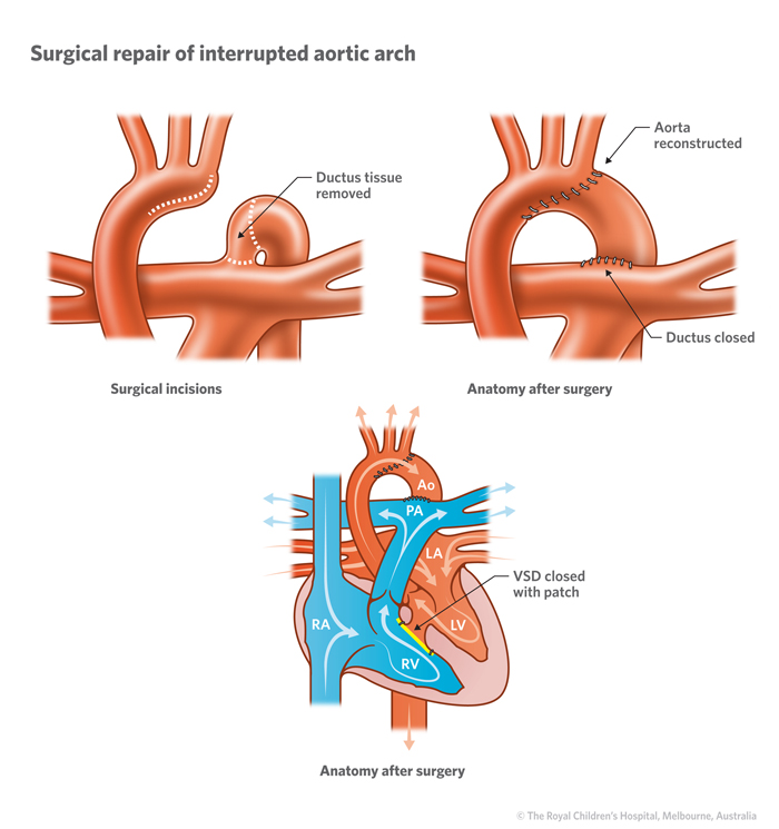 11b_Interrupted_aortic_arch