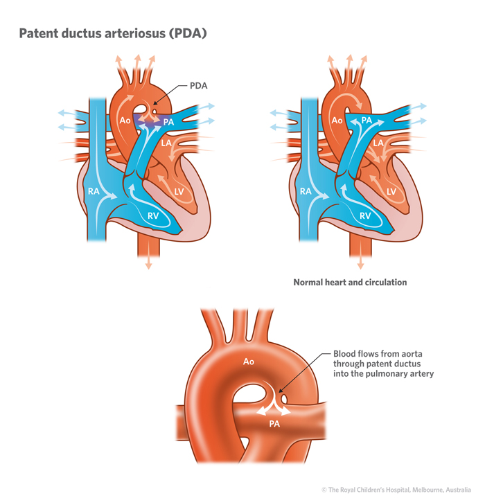 Cardiology : Patent Ductus Arteriosus PDA