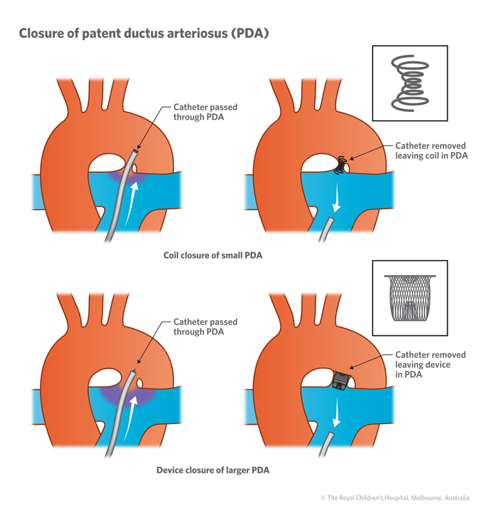 Patent Ductus Arteriosus Pathophysiology