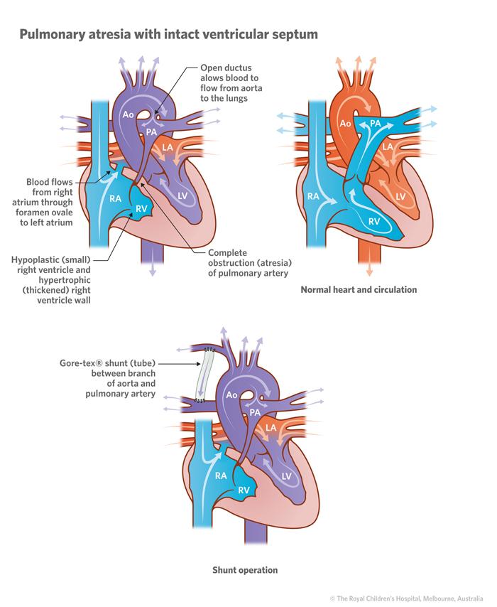 14a_Pulmonary_atresia_with_intact_ventricular_septum