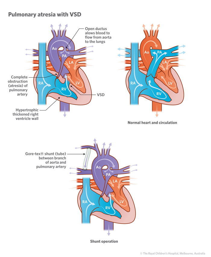 15a_Pulmonary_atresia_with_VSD