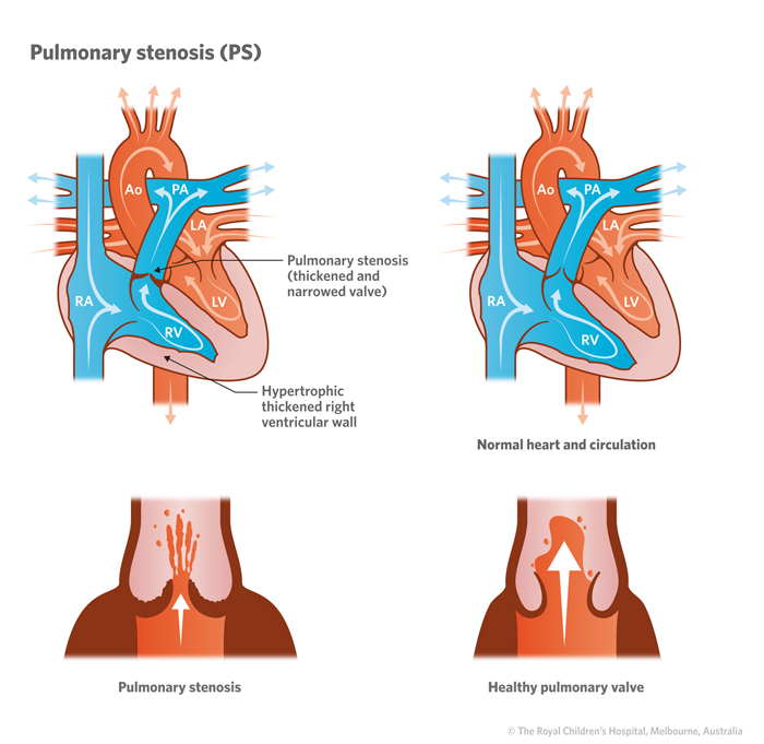 16a_Pulmonary_stenosis_PS