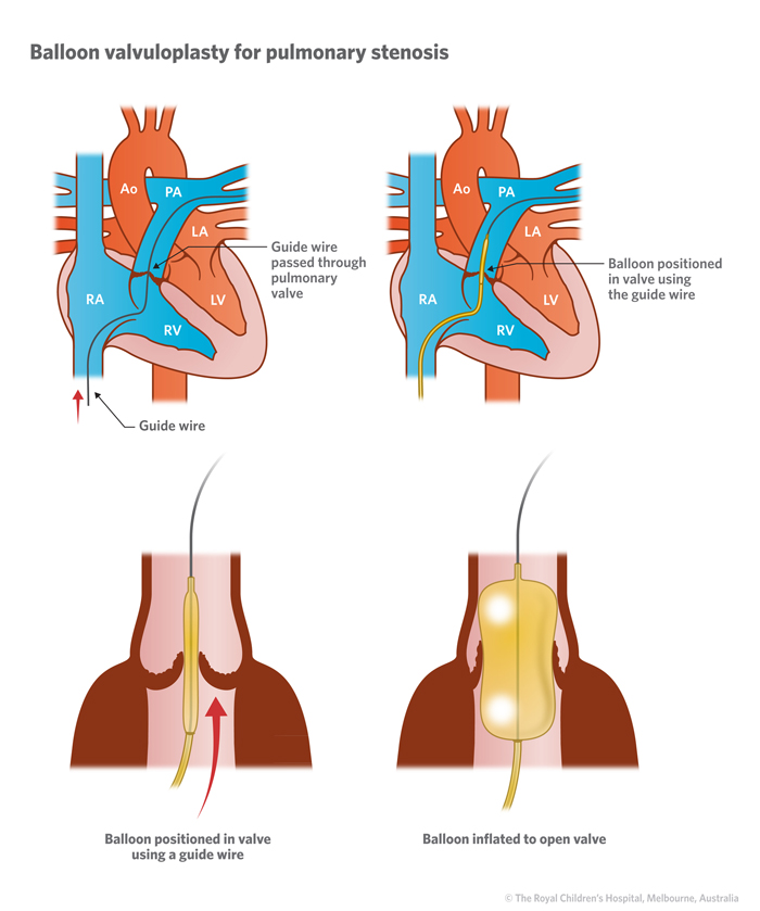 pulmonary valve