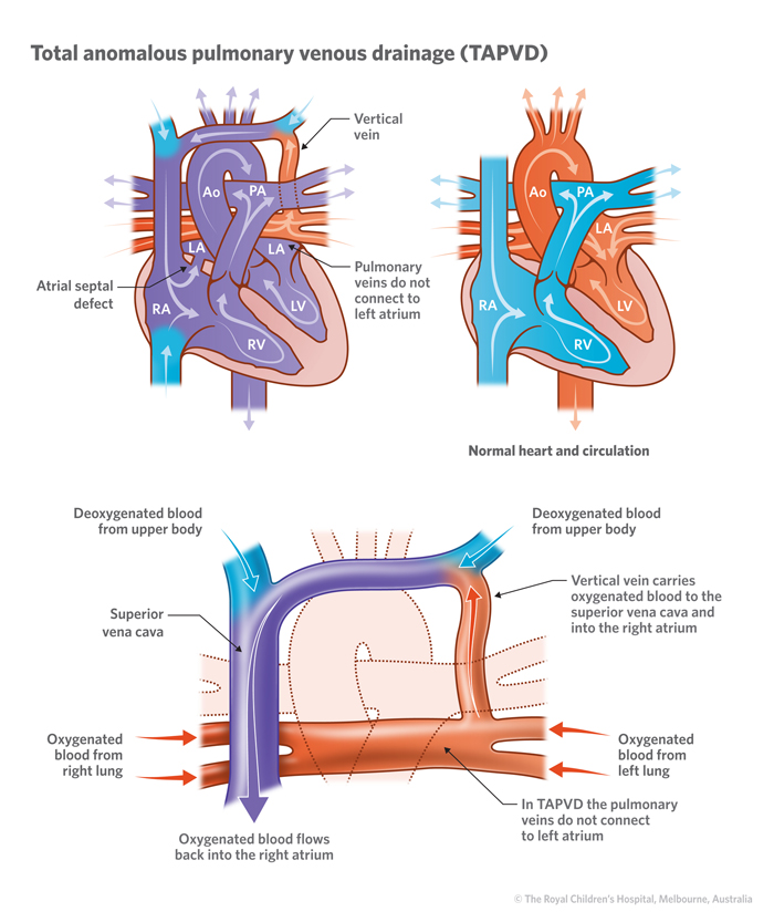 17a_Total_anomalous_pulmonary_venous_drainage