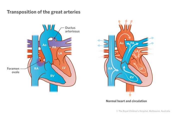 Cardiology : Transposition of the Great Arteries