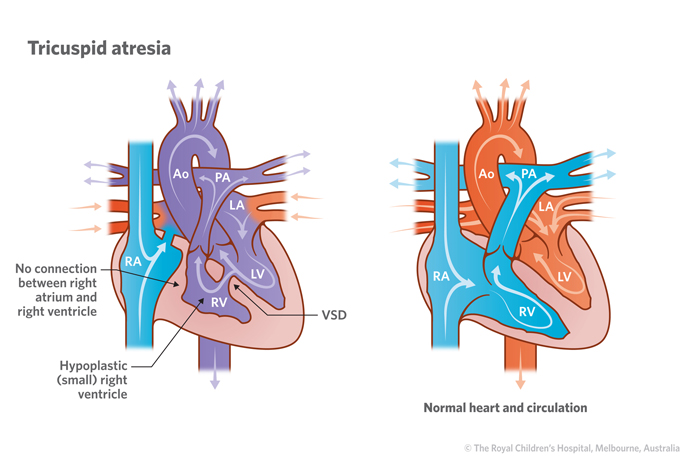 19a_Tricuspid_atresia