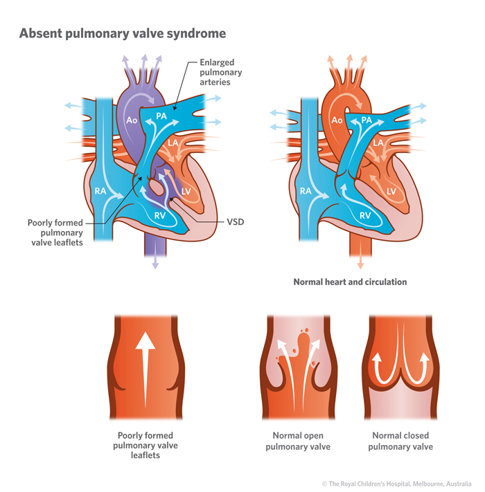 pulmonary valve